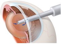 Лечение катаракты на начальной стадии